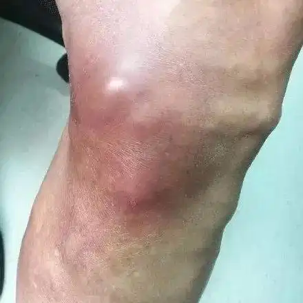 而这类患者最显著的表现是,曲张的静脉处出现红,肿,痛症状.