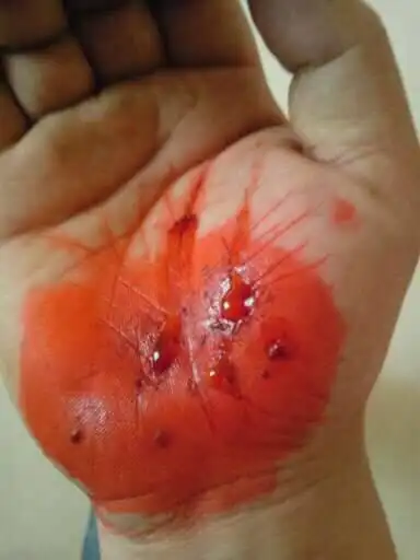 今天骑摩托车摔了一跤,手巴掌上蹭破了皮,后来去诊所做消毒处理了,给