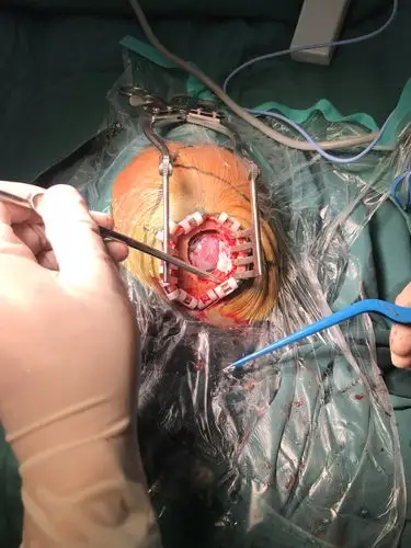 其它 神经内镜下脑出血清除术 写美篇详细向患者家属解释病情,手术