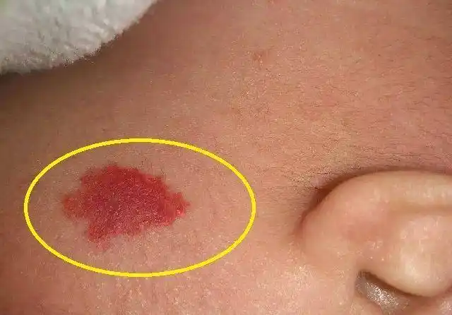 这些都会导致胎儿色素沉着,从而形成各种不同形状的胎记.