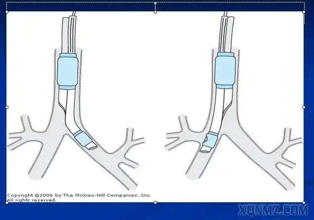 双腔支气管麻醉操作与管理之我见_圈子_医脉通