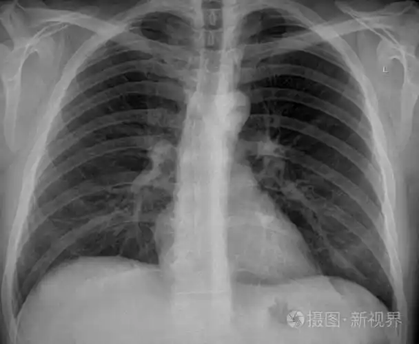 男性吸烟者肺部未经编辑的x线扫描前视可能有病理性硬结