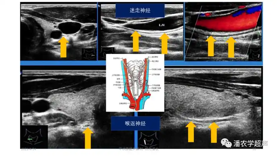 甲状腺超声解剖.