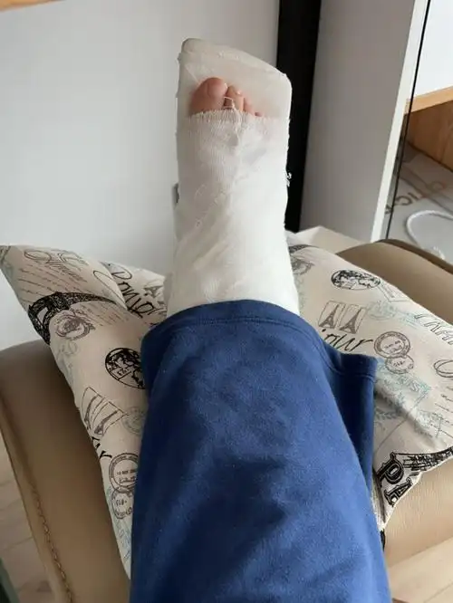 脚踝撕脱性骨折恢复心得及建议