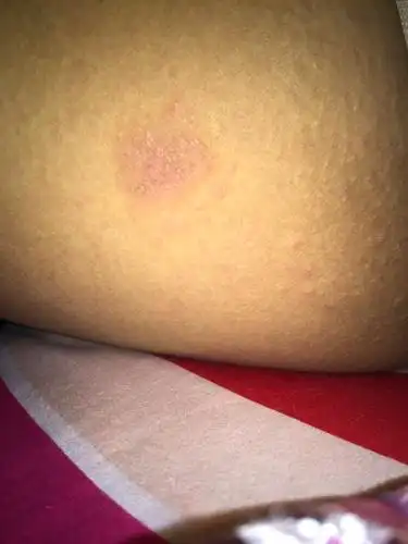 大腿内侧突然起来一推疙瘩,.怎么回事啊?现在哺乳期.没出去洗澡过.