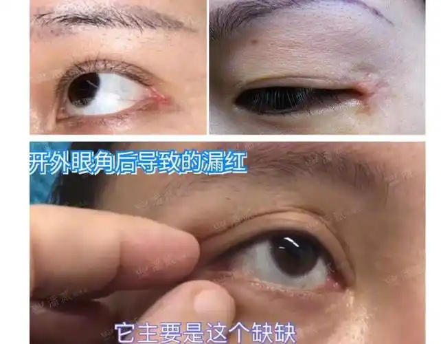 开外眼角和下至后遗症:下三白眼,结膜外露,不适,影响眼部健康|手术|黑