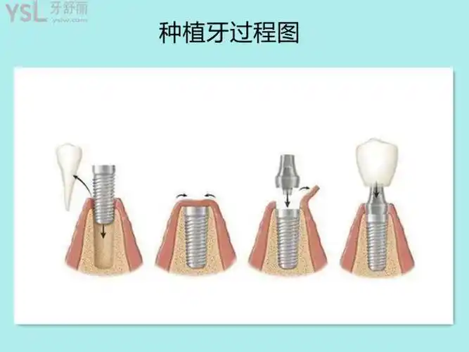 种植牙过程图