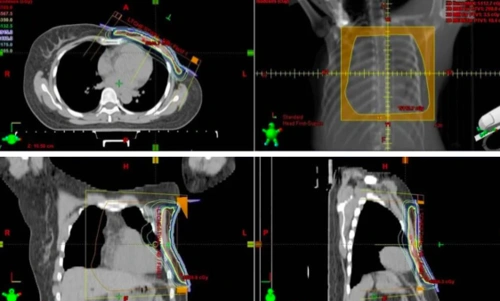乳腺癌术后放疗,15 次和 25 次有什么区别?