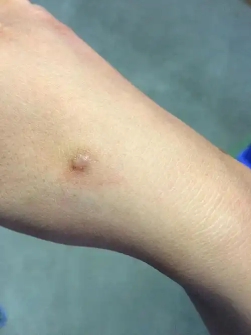 皮肤破了不愈合,反而变成这样子了,好难看,求懂的人帮我看看这是什么