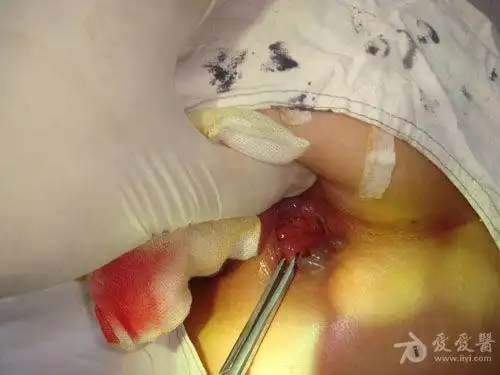 大家看看这个环形混合痔怎么做