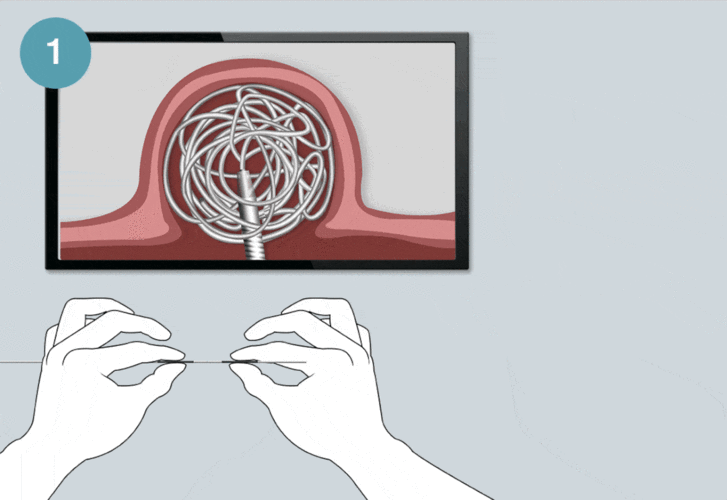 创新医疗器械沃比医疗机械解脱弹簧圈获批上市