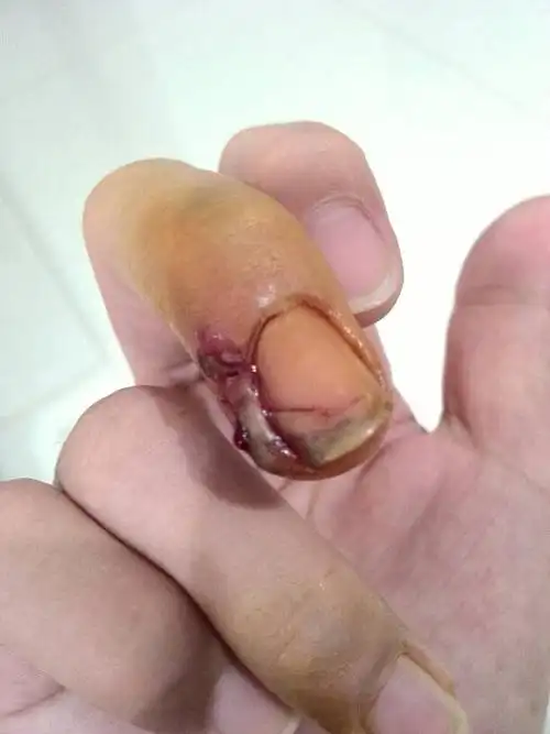 上班时手指被门夹伤了,表示生不如死,今天换了药,今晚拆了,还在流血
