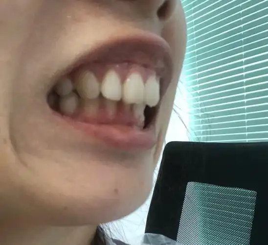 骨性龅牙嘴凸笑起来露牙龈下巴严重后缩