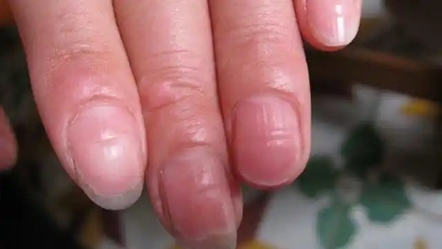 指甲出现3种"现象",可能是肝不好了,小心肝炎,肝硬化上门来