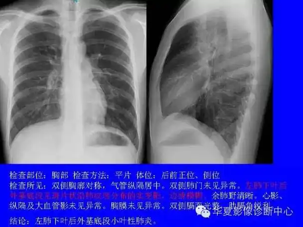胸部平片怎么读?