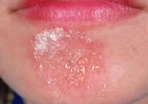 面部长癣是什么样子的面癣的治疗症状图片