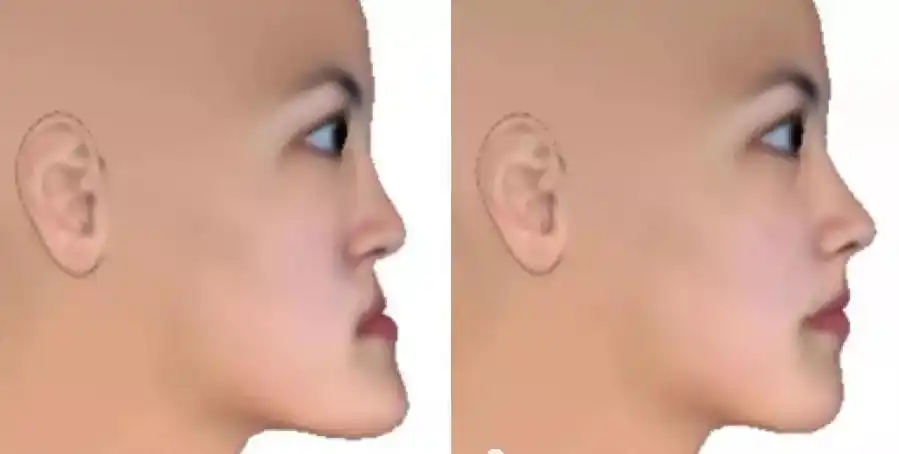 什么是面中部凹陷应该如何改善