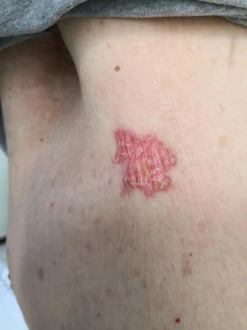 躯干部位大片红斑,边界清楚的红斑角化症状.汗孔角化症.