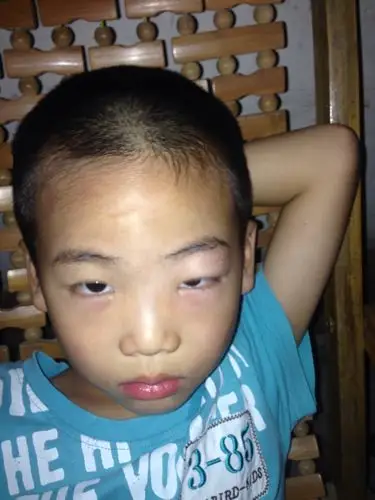 弟弟睡觉起来眼睛就变肿了,为什么?