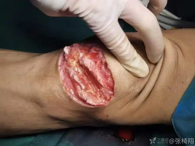 中年男性电动切割机割伤左膝部致左髌骨下极开放性粉碎性骨折髌韧带