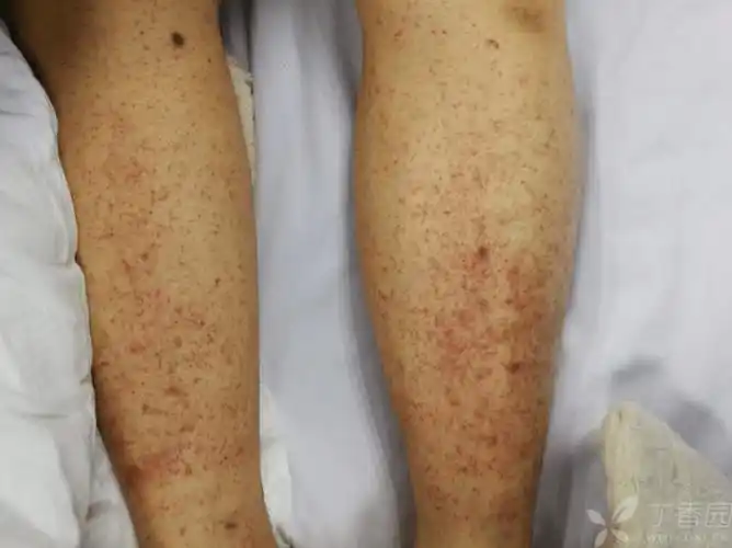 同样是瘀斑,过敏性紫癜与特发性血小板减少性紫癜有何不同