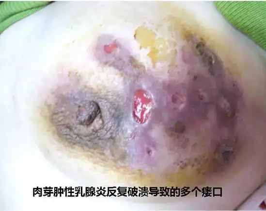浆细胞性乳腺炎与肉芽肿性乳腺炎一般发生在回乳之后的数年时间,当然