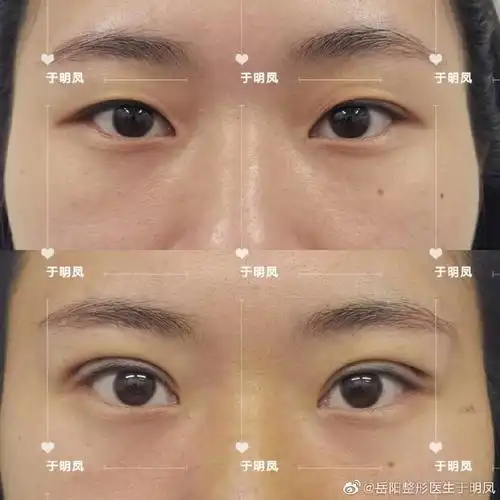 双眼皮岳阳整形上睑下垂