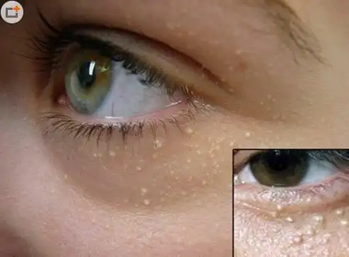 脸上的脂肪粒是怎么产生的?如何祛除脂肪粒?