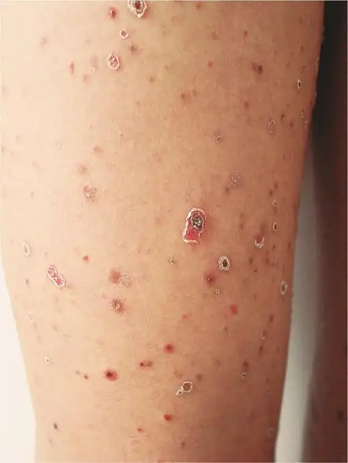 银屑病_疾病介绍_病因_症状_治疗方法_介绍_发病原因_症状表现_治疗