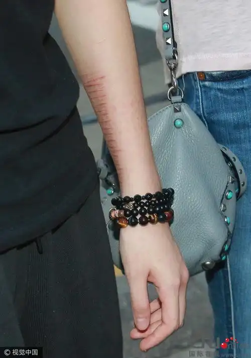 小龙女与妈妈似已和好手腕数十条自残伤疤明显