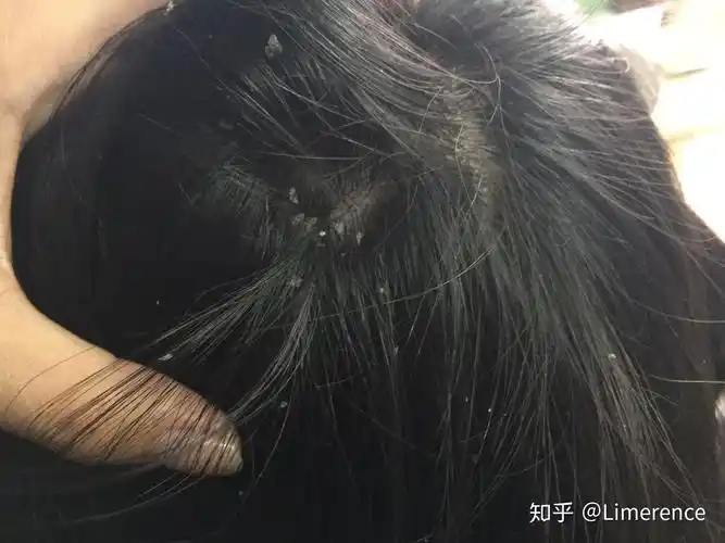 见过的最大头皮屑多大?