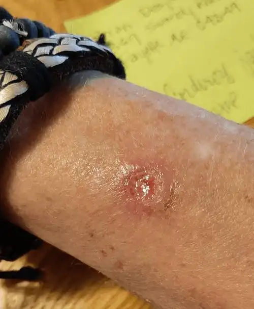 预防鳞状细胞癌 健康成为习惯 权威 专家 有效预防_皮肤_保护_进行