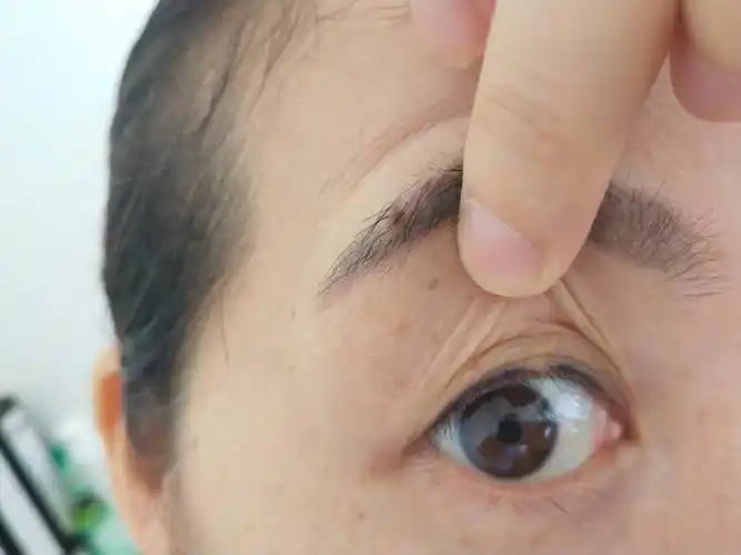 你好,我眼皮上长了个小肉肉,好多年了,不大,不疼