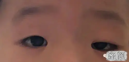 美然孩子上眼睑下垂什么时候手术合适
