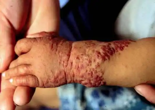 海绵状血管瘤(cavernous hemangioma)