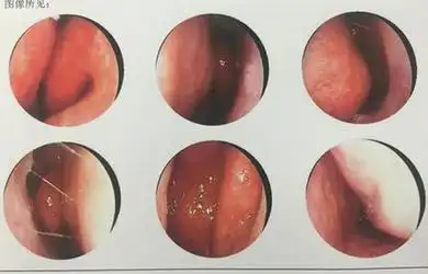 鼻中隔偏曲的治疗方法