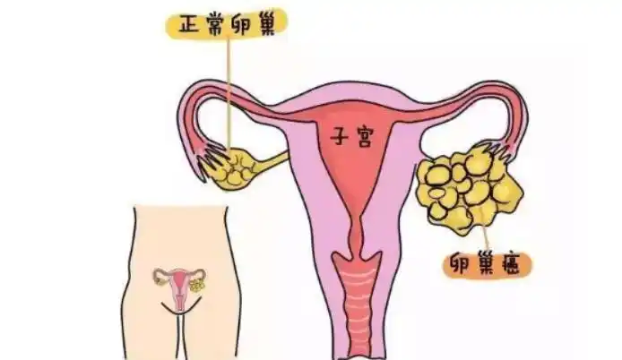 艾灸|卵巢癌|积液_新浪新闻