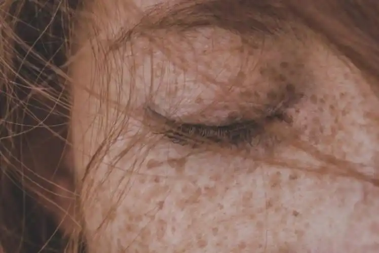 日晒斑怎么去除天然方法