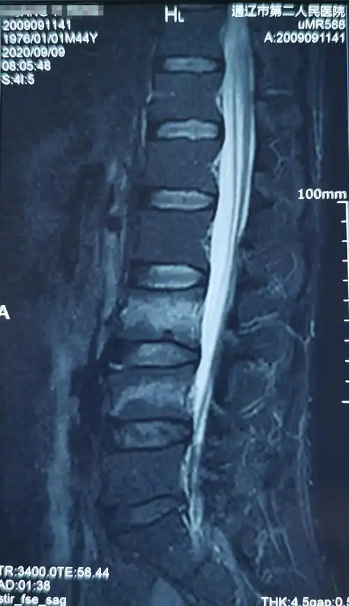 44岁腰椎3,4椎体压缩性骨折椎体成型手术一例