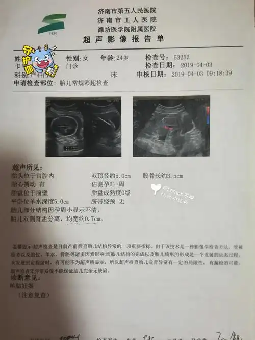 孕期胎儿双肾盂分离