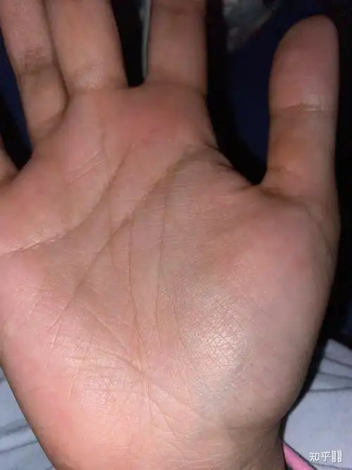 那些得癌症离开人世的年轻朋友,他们手心的生命线是不是很短?