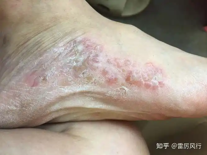 水泡型脚气怎么治啊tt快开学了好可怕啊该怎么去面对一个宿舍的人啊