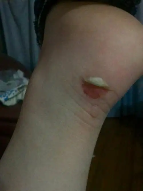 鞋太紧,脚跟磨破,好痛