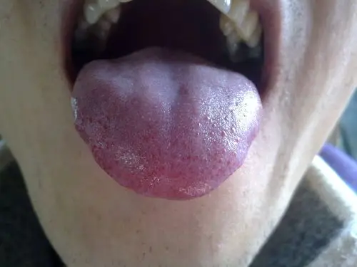 请大家帮我看看我的舌头 是艾滋病吗 好害怕啊