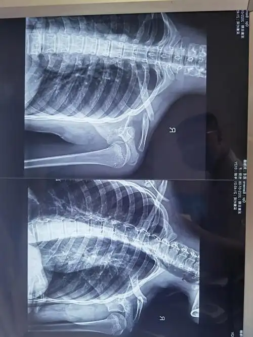 小姑娘12岁锁骨骨折第三张是术后的皮肤