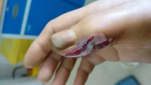 各位老师看看用小针刀做拇指狭窄性腱鞘炎术后的麻烦事