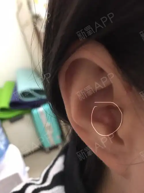 切除耳软骨半年左右后 下耳窝里长了一个硬疙瘩 硬硬的 摸着不