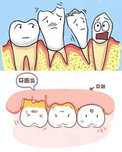 牙周炎早发现早治疗!千万不要拖!