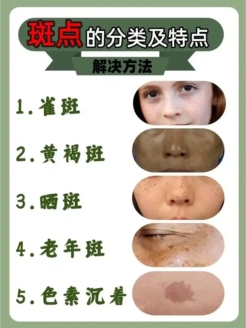 斑点皮肤的分类以及特点#美白淡斑 #袪斑 #淡化斑点 - 抖音