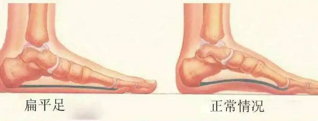 超过这个年龄还没有足弓,很可能会是扁平足!